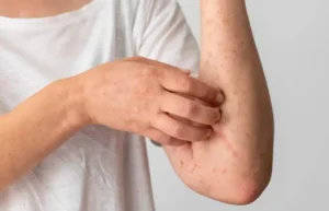 skin inflammation